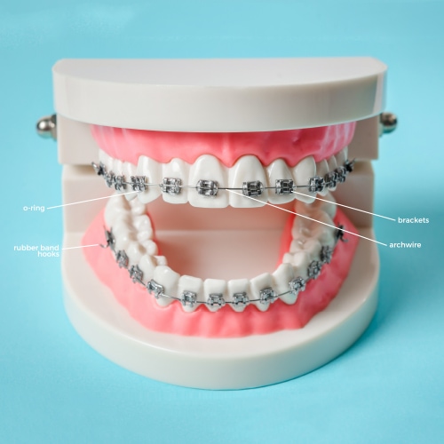 A model of a braces on a blue background.