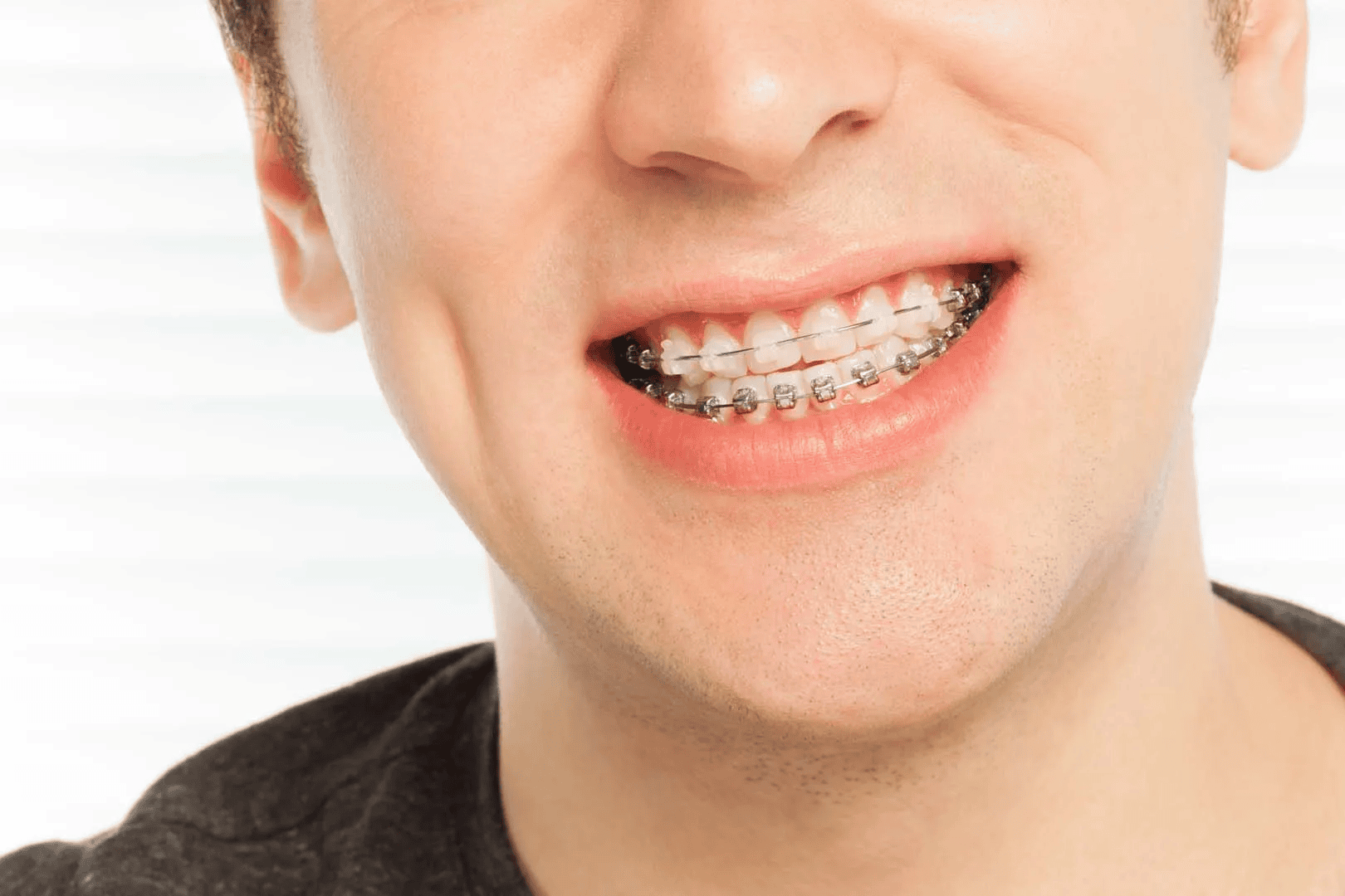 clear-braces-Bellevue-wa